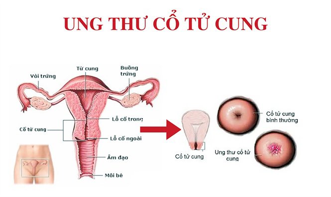 RA MÁU SAU CHU KỲ KINH - BIỂU HIỆN CỦA BỆNH NGUY HIỂM